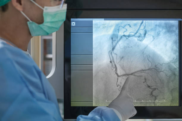 angiografía coronaria. imagen de rayos x - angioplasty fotografías e imágenes de stock