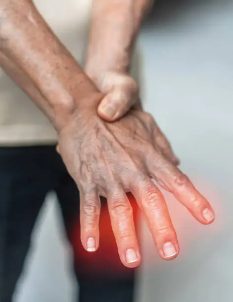 Photo of Peripheral Neuropathy pain in elderly patient on hand, palm, fingers and sensory nerves with numb, aching, muscle weakness, stabbing, burning from chronic inflammatory demyelinating polyneuropathy