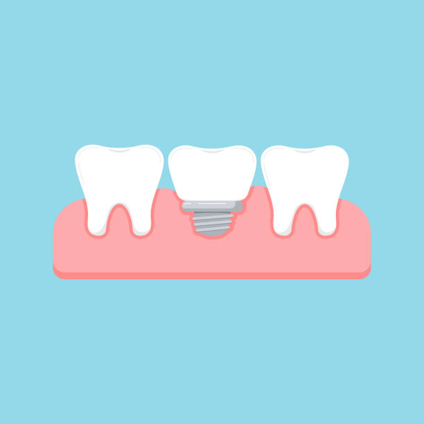 Root Canal Treatment Cartoons Illustrations, Royalty-Free Vector Graphics & Clip Art - iStock Root Canal Treatment Cartoons Illustrations, Royalty-Free Vector Graphics & Clip Art - iStock
