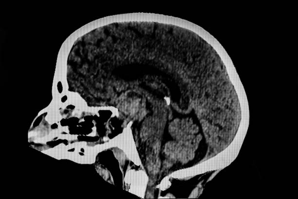 istock CAT Scan image of injury brain. 1303374894