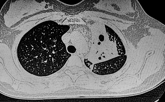 CAT Scan of young female with breast prosthesis and left upper lobe pulmonary tuberculosis. Medical themes