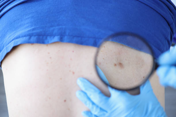 istock Doctor examines patient's back with moles through magnifying glass 1303457000