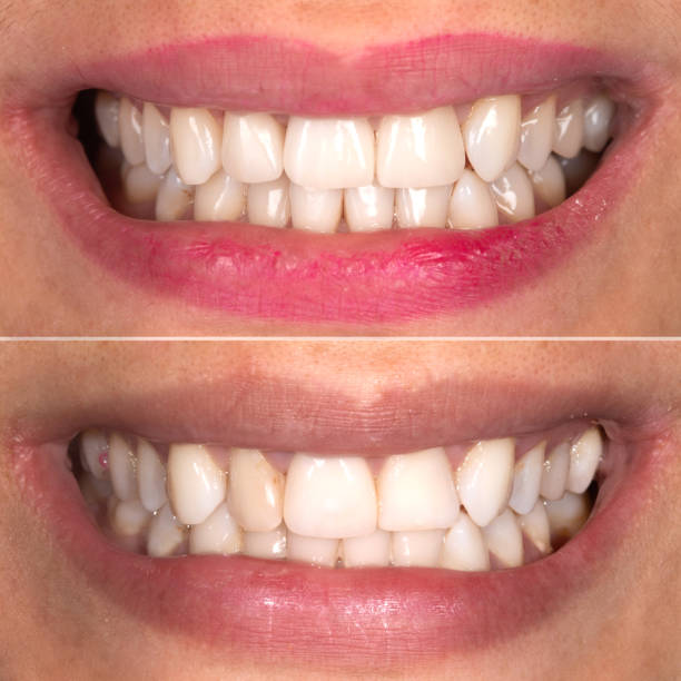 istock Perfect smile before and after bleaching procedure whitening of zircon arch ceramic prothesis Implants crowns. Dental restoration treatment clinic patient. Result of oral surgery dentistry, 1303468721