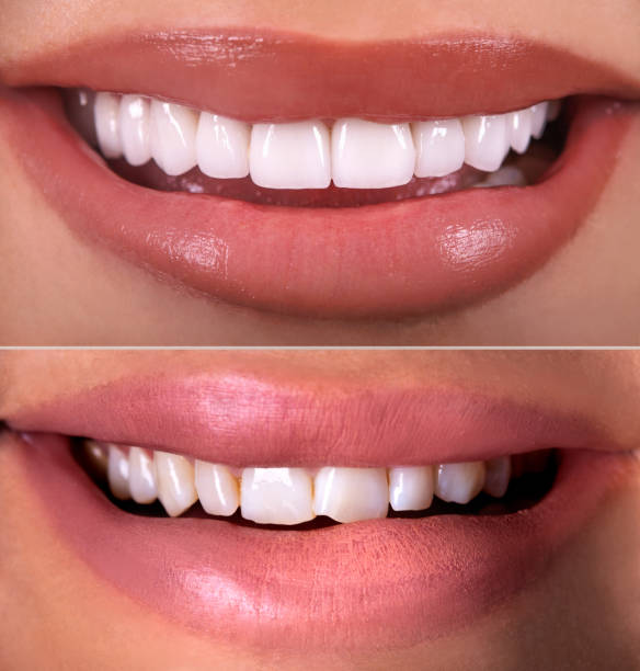 Perfect smile before and after bleaching procedure whitening of zircon arch ceramic prothesis Implants crowns. Dental restoration treatment clinic patient. Result of oral surgery dentistry, Perfect smile before and after bleaching procedure whitening of zircon arch ceramic prothesis Implants crowns. Dental restoration treatment clinic patient. Result of oral surgery dentistry, dental equipment photos stock pictures, royalty-free photos & images