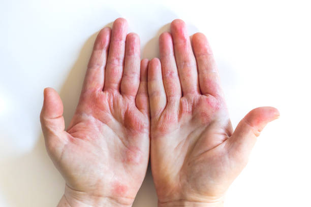 istock Strong allergic eczema on hands. Red, cracked skin with blisters 1303544321
