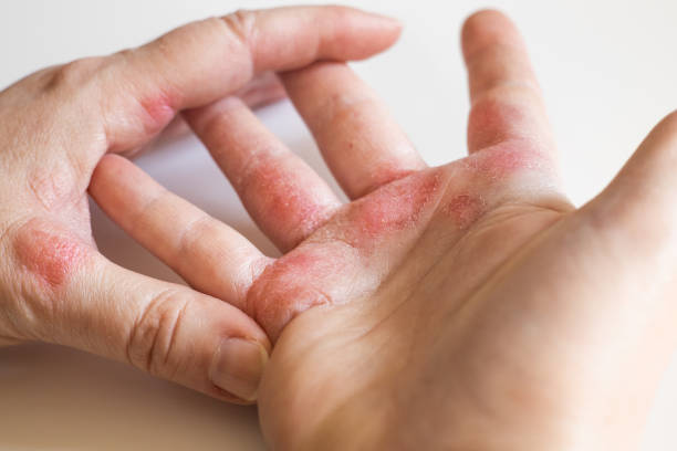 Strong allergic eczema on hands. Red, cracked skin with blisters Strong allergic eczema on hands. Red, cracked skin with blisters eczema stock pictures, royalty-free photos & images