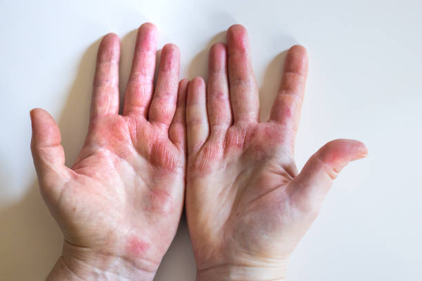 istock Strong allergic eczema on hands. Red, cracked skin with blisters 1303544331