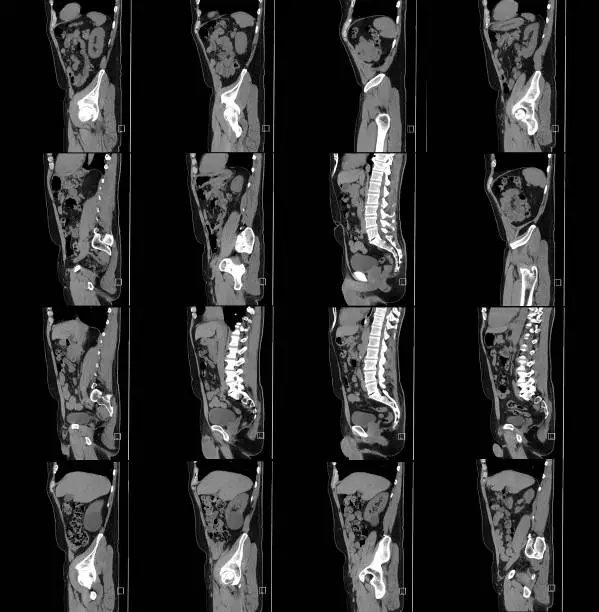 Photo of Abdomen Pelvis Cat Scan Side View