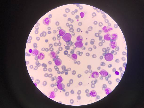 미숙하고 성숙한 백혈구. 세분화된 호중구, 폭발 세포 밀로세포, 대사세포, 밴드 형태. - leukemia pathologist blood hematologist 뉴스 사진 이미지
