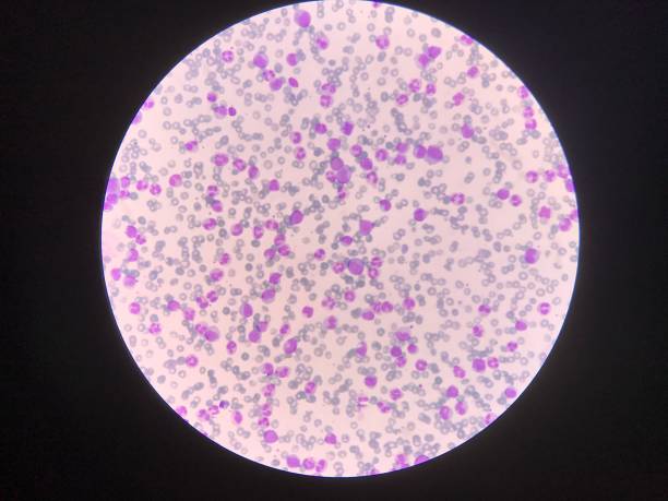 미숙하고 성숙한 백혈구. 세분화된 호중구, 폭발 세포 밀로세포, 대사세포, 밴드 형태. - leukemia pathologist blood hematologist 뉴스 사진 이미지