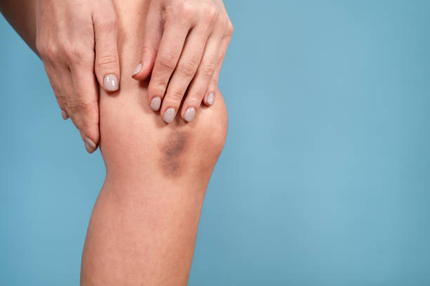 Young woman with a hematoma. Victim of domestic violence. Bruise on woman's leg skin. Do not be silent about violence concept Young woman with a hematoma. Victim of domestic violence. Bruise on woman's leg skin. Do not be silent about violence concept . High quality photo knee contusion bruised knee stock pictures, royalty-free photos & images