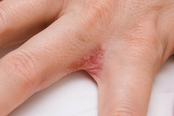 istock Hand with interdigital dermatitis, dyshidrotic eczema on hand close up 1303919728