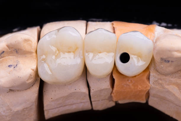 Dental dentist crown bridge, Implant