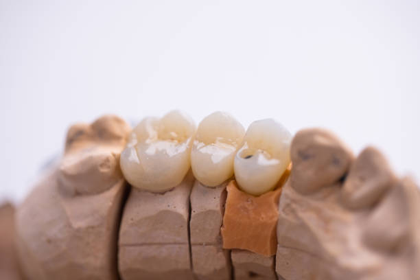 metal-ceramic crowns on gypsum dental models