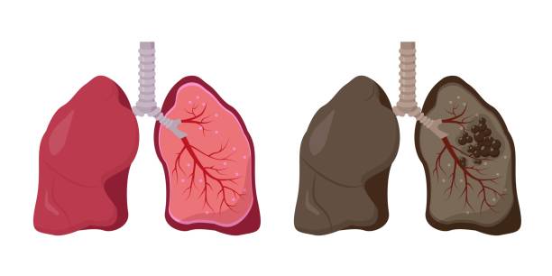 859 Cartoon Of Lungs From Smoking Illustrations & Clip Art - iStock