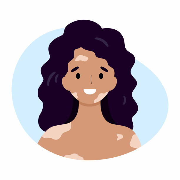 A happy woman with vitiligo. The girl suffers from problems with the skin of the face and body. A happy woman with vitiligo. The girl suffers from problems with the skin of the face and body. vitiligo stock illustrations