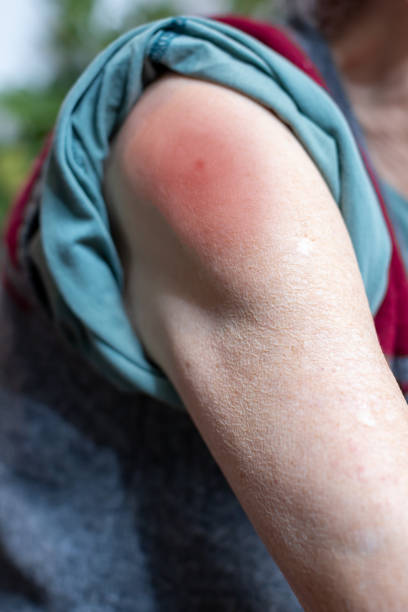 istock vaccine irritation on elderly woman's arm 1304244831