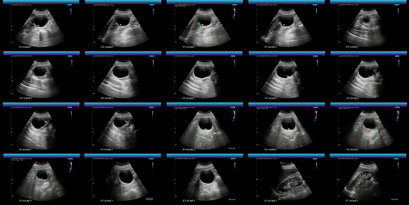 There is a cortical cyst in the lower pole of the right kidney measuring 6.1 x 6.1 x 6.1 cm, with the upper thin posterior separation containing calcification 3 mm thick.  This is most probably benign Bosniak 2-2F. No suspicious renal mass, stone or hydronephrosis.  The unopacified renal collection system appears grossly normal.