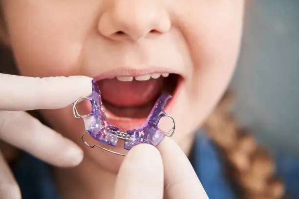 Cropped view of the little girl with her mouth open sitting at the dentist's chair while the orthodontist holding the plate on her teeth. Dentist putting plate at child mouth