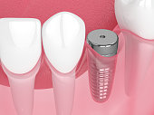 3d-render-des-kiefers-mit-implantatschraube-und-heilkappe.jpg?b=1&s=170x170&k=20&c=HZ4tGmB7B9pI00CEvaPQnsxjWEbX3BzPb8TThfadr4c=