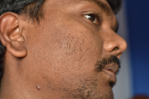 Close up of pimples marks on man's face . Deep acne scars on the cheek. Selective focus.
