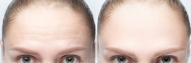 Forehead wrinkles before and after injection, treatment, surgery. Womans face close up Forehead wrinkles before and after injection, treatment, surgery. Womans face close up. botox before and after stock pictures, royalty-free photos & images