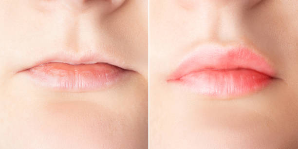 Lip augmentation before and after close up. Woman lips surgery, filler injection, mesotherapy, correction Lip augmentation before and after close up. Woman lips surgery, filler injection, mesotherapy, correction. permanent makeup before and after stock pictures, royalty-free photos & images