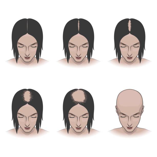 ilustrações, clipart, desenhos animados e ícones de estágios de queda de cabelo feminino - alopecia antes depois