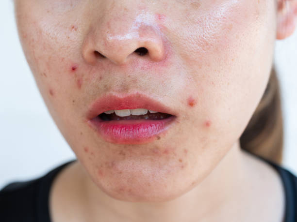 istock Woman having problems of acne inflamed on her lower face. 1304469917
