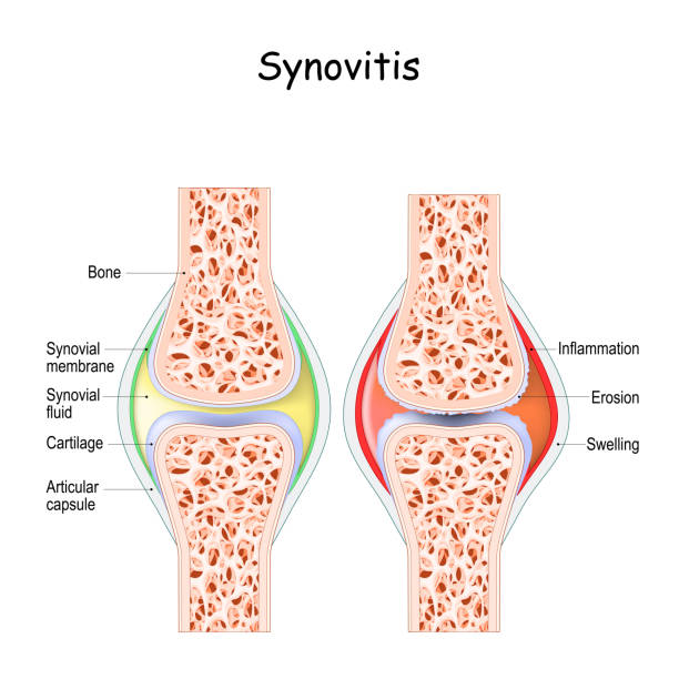 istock synovitis. healthy joint and a joint with inflammation of the synovial membrane. 1304495808