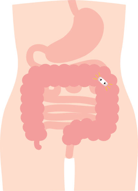 This is an illustration of a capsule colonoscopy. This is an illustration of a capsule colonoscopy. colon cancer screening stock illustrations