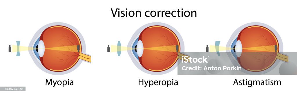Ilustración de Corrección De Varios Trastornos De La Visión Ocular Lente Hipermetropía Miopía Astigmatismo Ilustración Vectorial y más Vectores Libres de Derechos de Globo ocular - iStock
