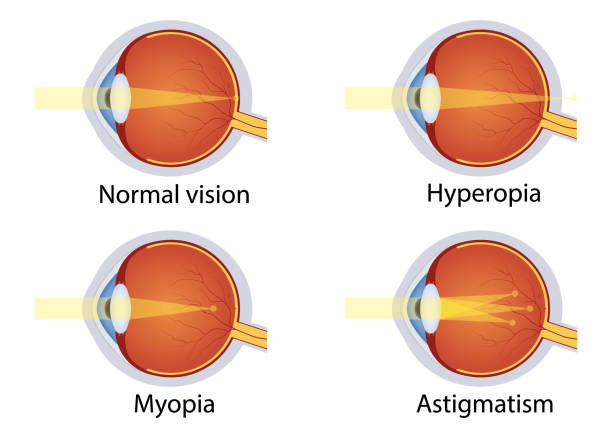 Vision disorders. Concept of eyes defect. Normal vision, hyperopia, myopia, astigmatism. Anatomy eyeball. Vector Vision disorders. Concept of eyes defect. Normal vision, hyperopia, myopia, astigmatism. Anatomy eyeball. Vector defection stock illustrations