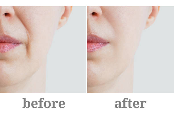 primo piano della piega nasolabiale sul volto di una donna caucasica. prima e dopo. - bocca umana foto e immagini stock