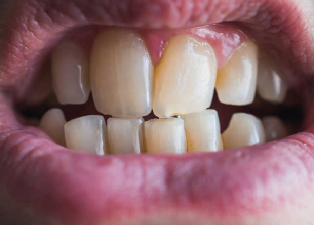 istock Man´s mouth close up showing teeth. Dentist concept 1304902589