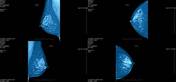 Mammogram Bilateral With Annotations stock photo