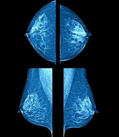 Four, side view, X-ray pictures of a woman's two breasts. On the right, lateral breast there are two intramammary lymph nodes with fatty hilum measuring 0.5 and 0.6 cm respectively. No suspicious breast mass or auxiliary lymphadenopathy. Moderately dense breasts with 50 to 75 % glandular tissue.  Bi-RADS 2 : benign findings.