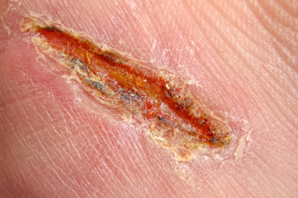 A wound that heals. Close-up of a cut on the skin. stock photo