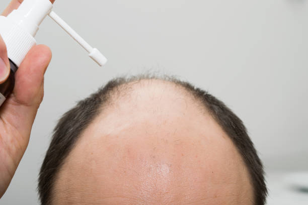 the head of a bald man using a hair growth remedy. androgenetic alopecia - completely bald fotos imagens e fotografias de stock