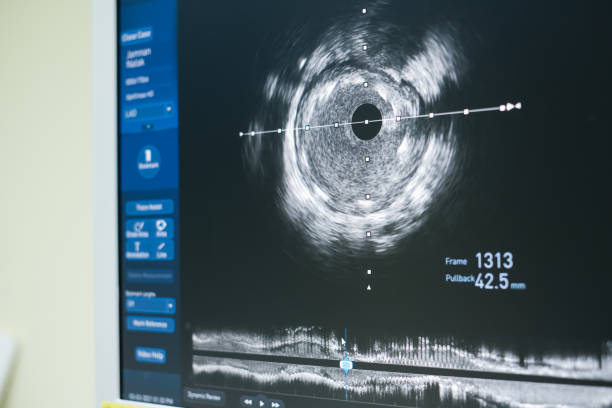 istock Intravascular ultrasound imaging (IVUS) 1305076141