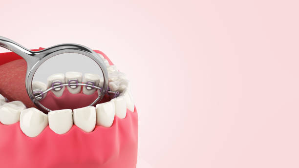 lingual braces sistema en una demostración de dentadura 3d de cerca en el degradado de color - lingual fotografías e imágenes de stock