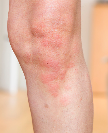 Erupción cutánea (urticaria), afección de la piel, alergia a la piel en el cuerpo, Reino Unido photo