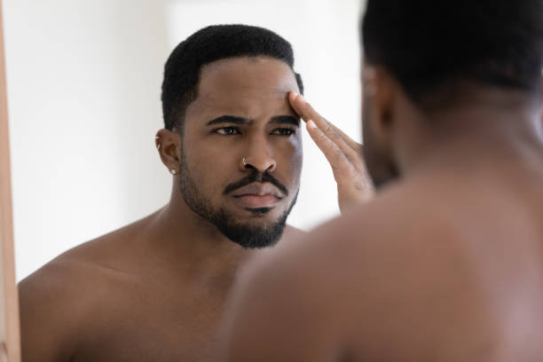 istock Stressed young african american man feeling dissatisfied with skin condition. 1305364270