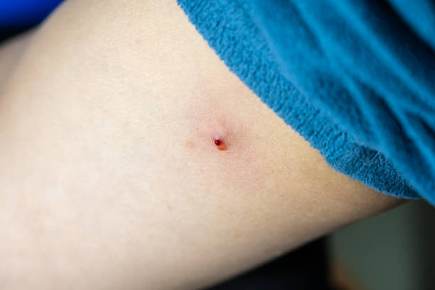 istock An arm with a drop of blood after squeezing a pimple 1305502666