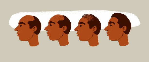 illustrations, cliparts, dessins animés et icônes de illustration du processus de transplantation de cheveux sur la tête d’un homme. calvitie, problèmes de croissance des cheveux, restauration des cheveux - balding completely bald men retro revival