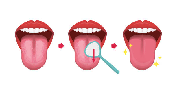 stockillustraties, clipart, cartoons en iconen met hoe maak je je tong vector illustratie schoon (halitose preventie) - mensentong
