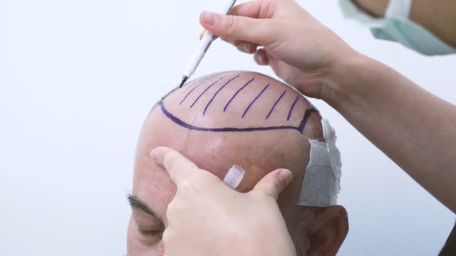 Hair Transplant Stock Videos and Royalty-Free Footage - iStock