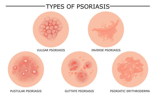illustrations, cliparts, dessins animés et icônes de différents types de vecteurs du psoriasis - psoriasis