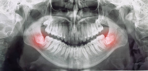 different types of wisdom teeth problems concept different types of wisdom teeth problems concept, problem teeth X-ray image scanned, panoramic image wisdom-teeth stock pictures, royalty-free photos & images