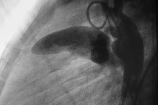die aortographie zeigte den patent ductus arteriosus (pda) bei pädiatrischen patienten, bei denen es sich um eine angeborene herzerkrankung handelt. - human heart heart attack x ray image chest stock-fotos und bilder